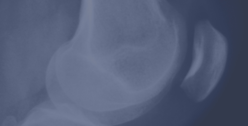 Knee joint meniscus x-ray test scan