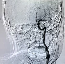 Thrombus Retrieval1