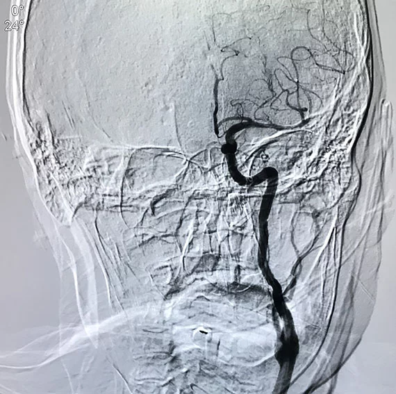 Thrombus Retrieval Component